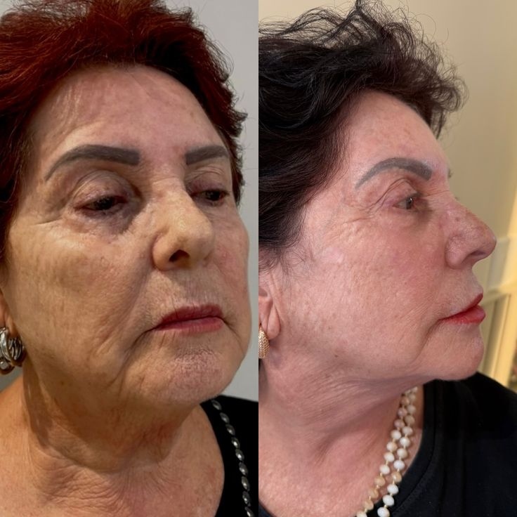 לפני ואחרי - הרמת קו הלחי